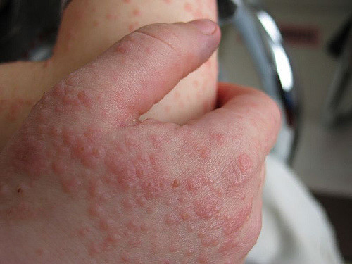 Rash Due To Epstein Barr Virus Infection Why And How To Help MedGuidance